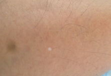 白癜风可以吃小白瓜吗,营养与健康的双重选择